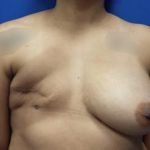 Tissue Expander To Implant Breast Reconstruction Before & After Patient #4399