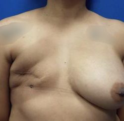 Tissue Expander To Implant Breast Reconstruction Before & After Patient #4399