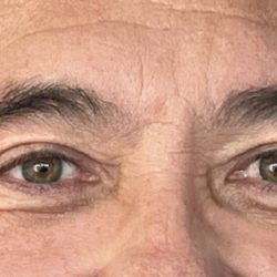 Upper Blepharoplasty Before & After Patient #4463
