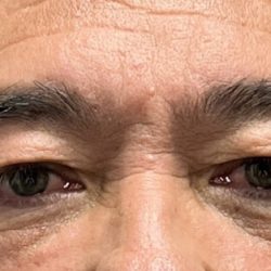 Upper Blepharoplasty Before & After Patient #4463