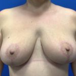 Breast Reduction Before & After Patient #4546