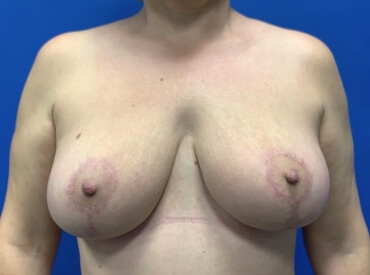 Breast Reduction Before & After Patient #4546