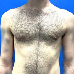 Gynecomastia Before & After Patient #4526