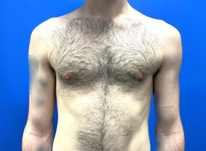 Gynecomastia Before & After Patient #4526