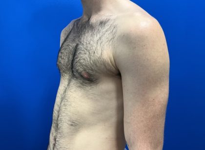 Gynecomastia Before & After Patient #4526