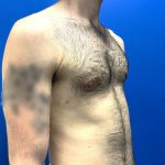 Gynecomastia Before & After Patient #4526