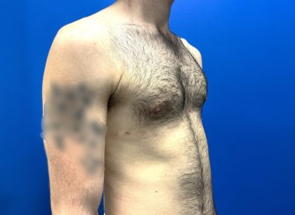 Gynecomastia Before & After Patient #4526