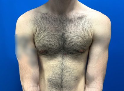 Gynecomastia Before & After Patient #4526