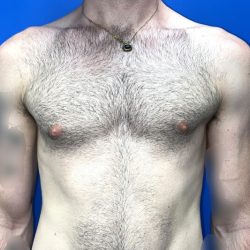 Gynecomastia Before & After Patient #4526