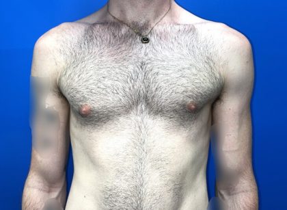 Gynecomastia Before & After Patient #4526