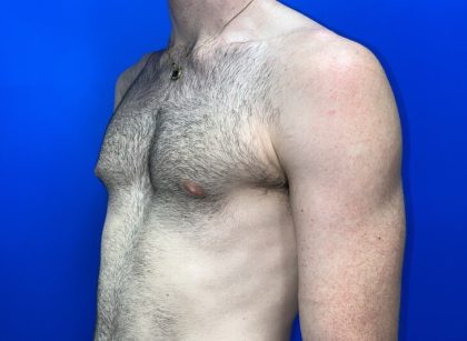 Gynecomastia Before & After Patient #4526