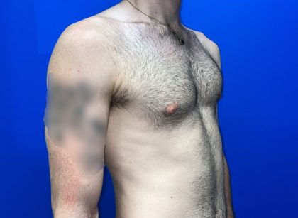 Gynecomastia Before & After Patient #4526