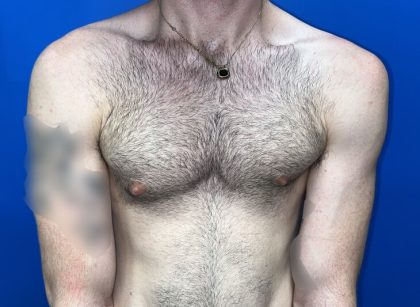 Gynecomastia Before & After Patient #4526