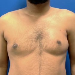 Poland Syndrome Before & After Patient #4567