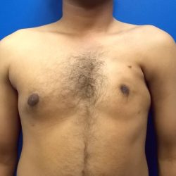 Poland Syndrome Before & After Patient #4567