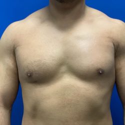 Poland Syndrome Before & After Patient #2121