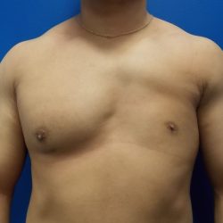 Poland Syndrome Before & After Patient #2121