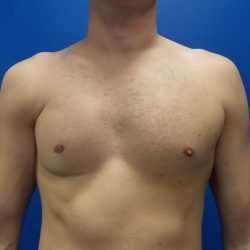 Poland Syndrome Before & After Patient #2124