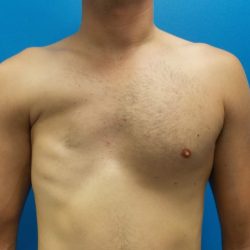 Poland Syndrome Before & After Patient #2124