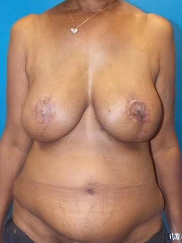 TRAM Flap Breast Reconstruction Before & After Patient #4553