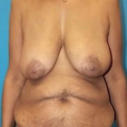 TRAM Flap Breast Reconstruction Before & After Patient #4553