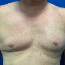 Poland Syndrome Before & After Patient #4607