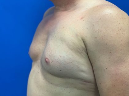 Poland Syndrome Before & After Patient #4607