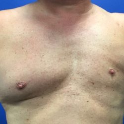 Poland Syndrome Before & After Patient #4607