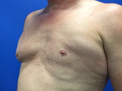 Poland Syndrome Before & After Patient #4607