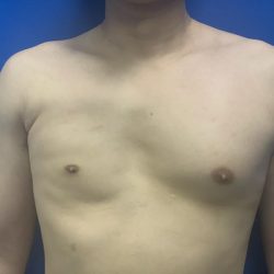 Poland Syndrome Before & After Patient #4614