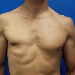 Poland Syndrome Before & After Patient #4598
