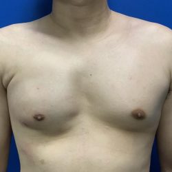 Poland Syndrome Before & After Patient #4614