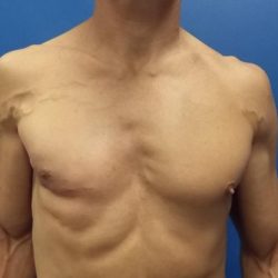 Poland Syndrome Before & After Patient #4598