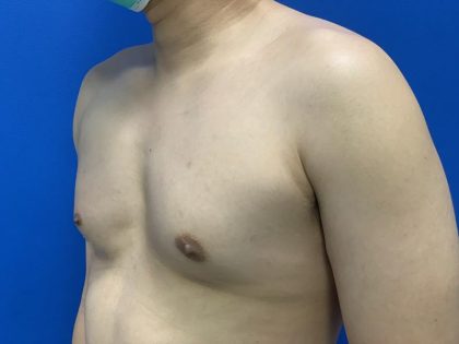 Poland Syndrome Before & After Patient #4614