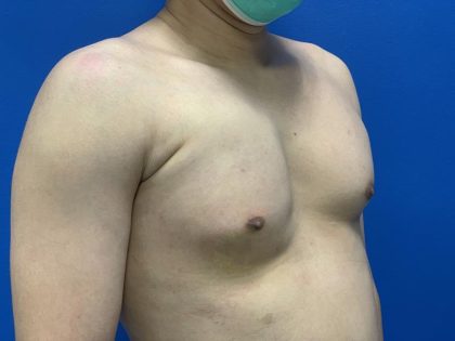 Poland Syndrome Before & After Patient #4614