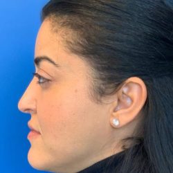 Rhinoplasty Before & After Patient #4646
