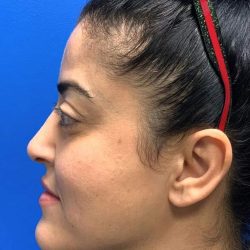 Rhinoplasty Before & After Patient #4646