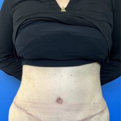 Tummy Tuck Before & After Patient #4623