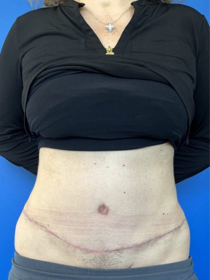 Tummy Tuck Before & After Patient #4623
