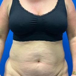 Tummy Tuck Before & After Patient #4623