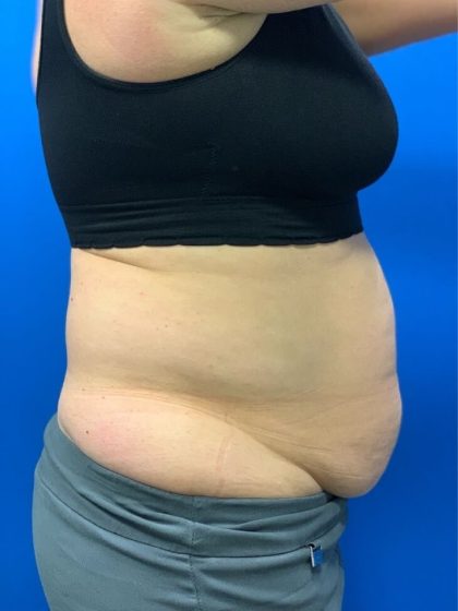 Tummy Tuck Before & After Patient #4623