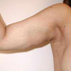 Arm Lift Before & After Patient #4682