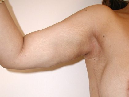 Arm Lift Before & After Patient #4682