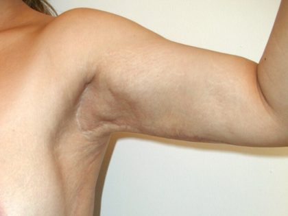 Arm Lift Before & After Patient #4682