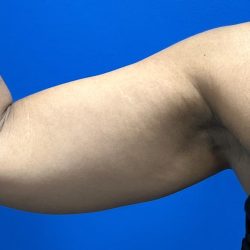 Liposuction Before & After Patient #4759