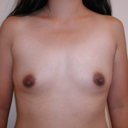 Breast Augmentation Before & After Patient #4691