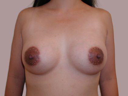 Breast Augmentation Before & After Patient #4691