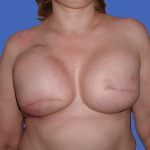 Tissue Expander To Implant Breast Reconstruction Before & After Patient #4748