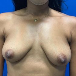 Breast Lift Before & After Patient #4739