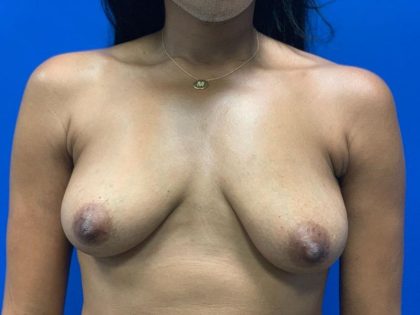 Breast Lift Before & After Patient #4739